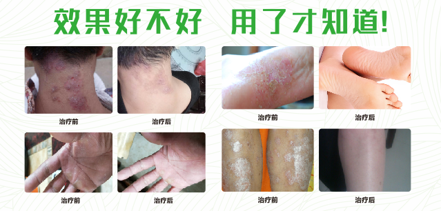 91视频免费网站真菌清喷剂